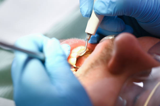 Best Emergency Tooth Extraction in Wood Dale, IL